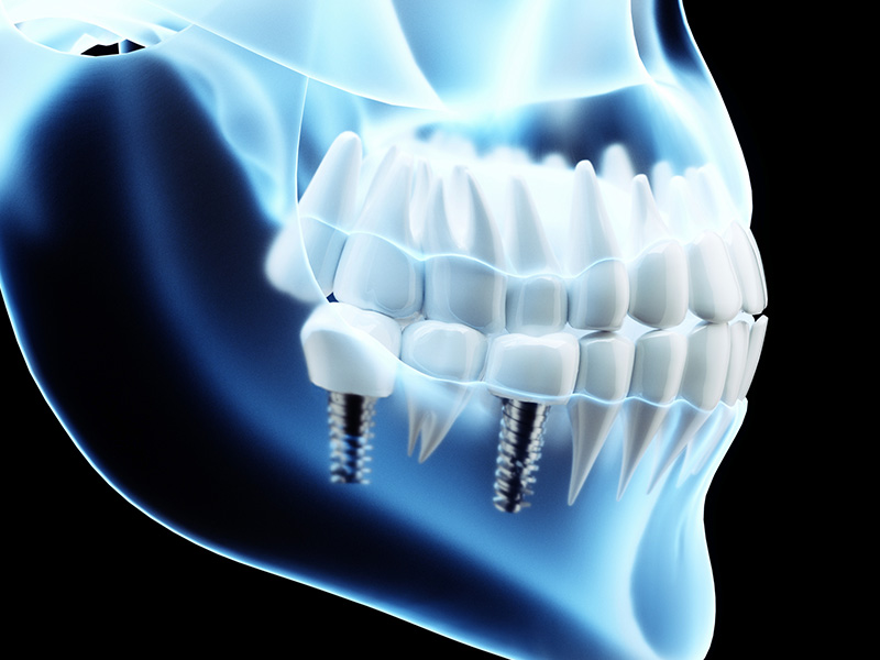 インプラントについて